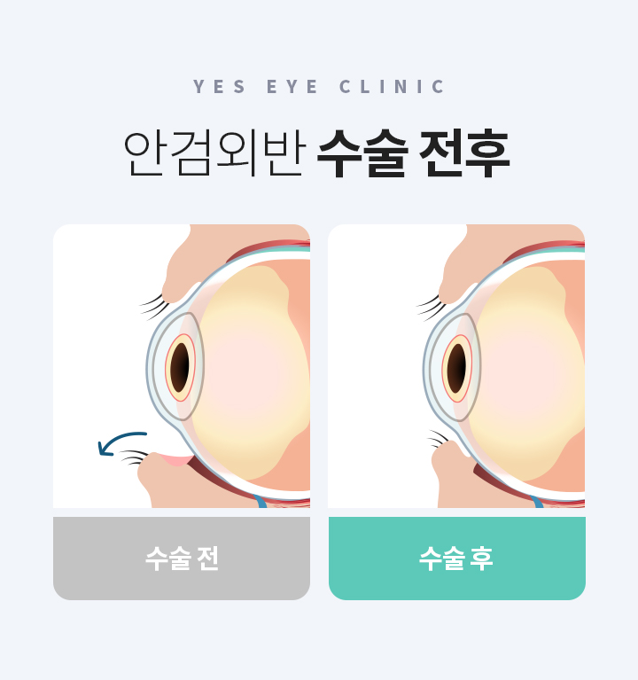 서브이미지